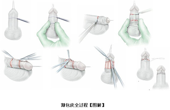 探索前沿包皮手术最新技术，保障男性健康