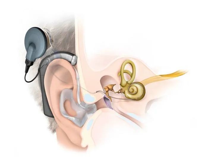 奥地利耳蜗最新款图片展示与详解
