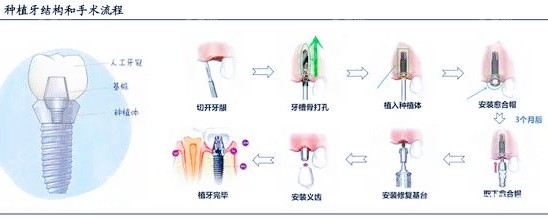 最新镶牙科技重塑牙齿美学的革命性进展